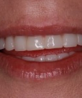 dental-implants-2-3